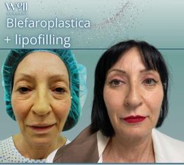 Well Surgery Blefaroplastica + lipofilling