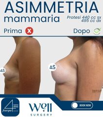 Well Surgery Asimmetria mammaria