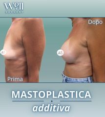 Well Surgery Mastoplastica additiva