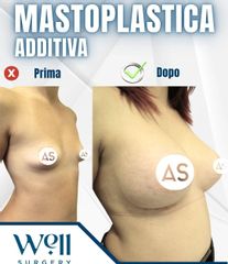 Well Surgery Mastoplastica additiva