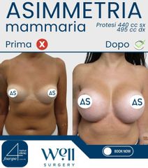 Well Surgery Asimmetria mammaria