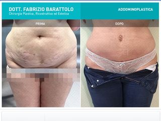 Addominoplastica prima dopo