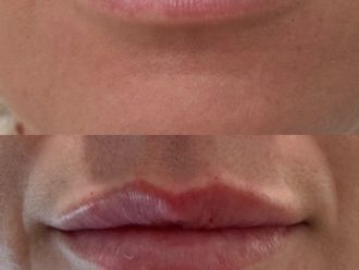 Filler labbra prima e dopo - 877744