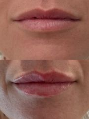 Dott.ssa Aurelia De Pascale Filler Labbra