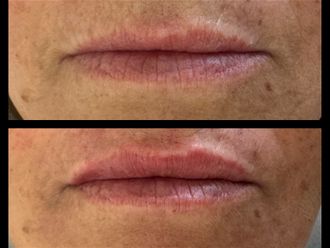 Filler labbra prima e dopo - 877745