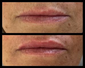Dott.ssa Aurelia De Pascale Filler Labbra