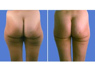Cellulite prima e dopo