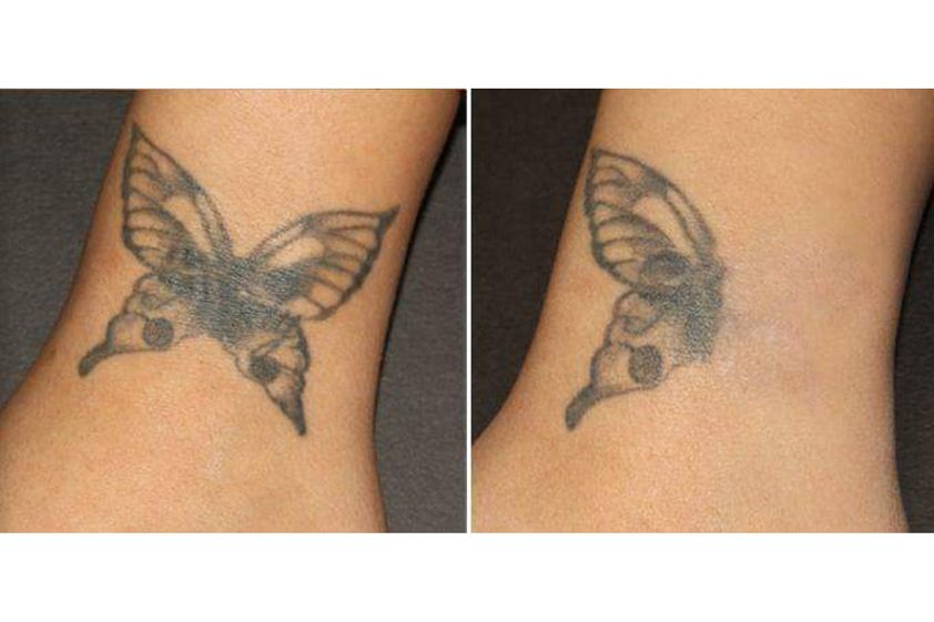 Rimozione tatuaggi prima e dopo - 798869