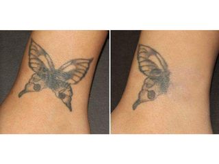 Rimozione tatuaggi - Dott.ssa Viviana Casagrande