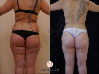 liposcultura total body prima e dopo