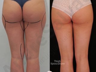 Liposuzione prima e dopo