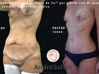 Addominoplastica prima e dopo
