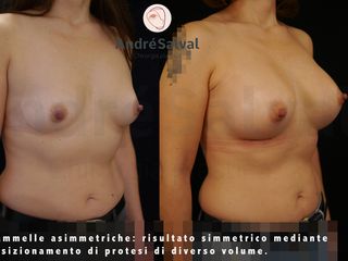 Asimmetria Mammaria prima e dopo