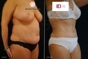 Lipoaddominoplastica prima e dopo