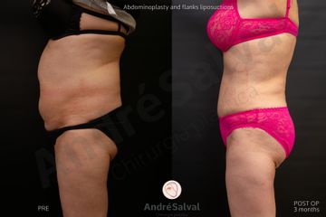 lipoaddominoplastica prima e dopo