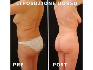 Liposuzione - Dott. André Salval