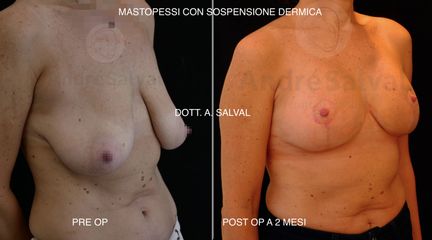 Mastopessi senza protesi - Dott. André Salval