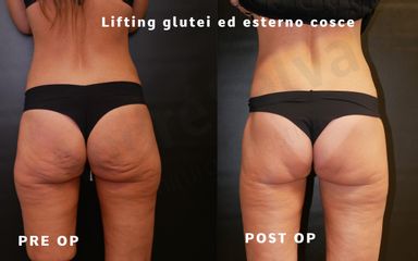 Lifting glutei - Medicina Estetica Dott. Lino Bertolini