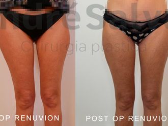 Liposcultura prima e dopo - 871181