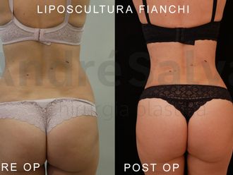 Liposcultura prima e dopo - 871183