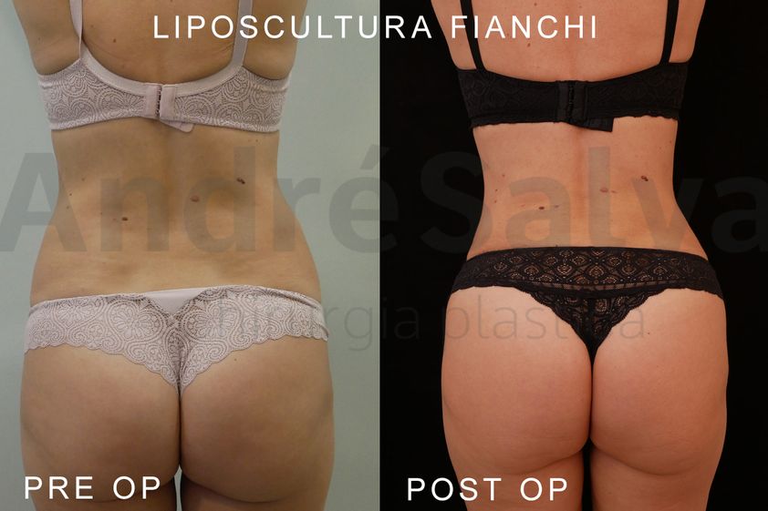 Liposcultura prima e dopo - 871183