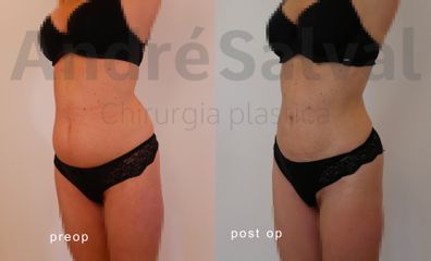 Dott. André Salval lipo e renuvion addome e fianchi