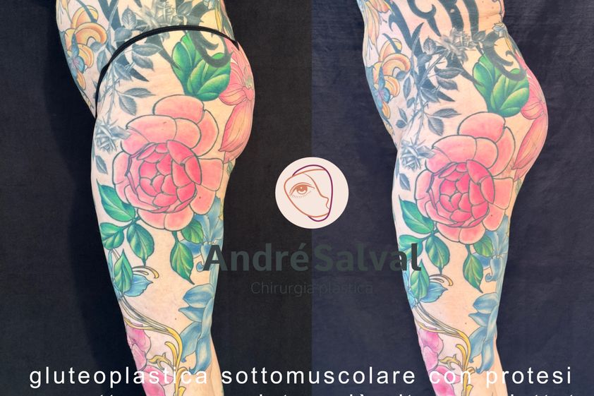 Gluteoplastica prima e dopo - 873235