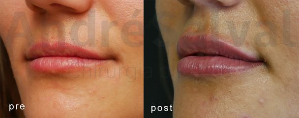 Dott. André Salval filler labbra