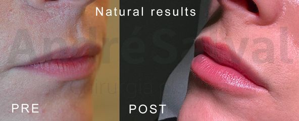 Dott. André Salval lips carr