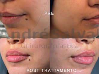 Acido ialuronico prima e dopo - 874702