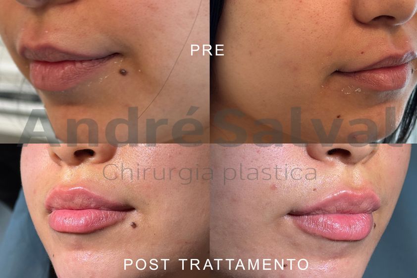Acido ialuronico prima e dopo - 874702