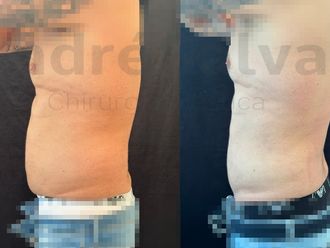 Liposcultura prima e dopo - 874703