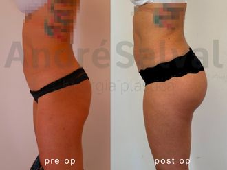 Gluteoplastica prima e dopo - 874894