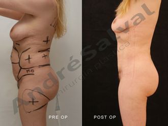 Lipo Vaser prima e dopo - 875130