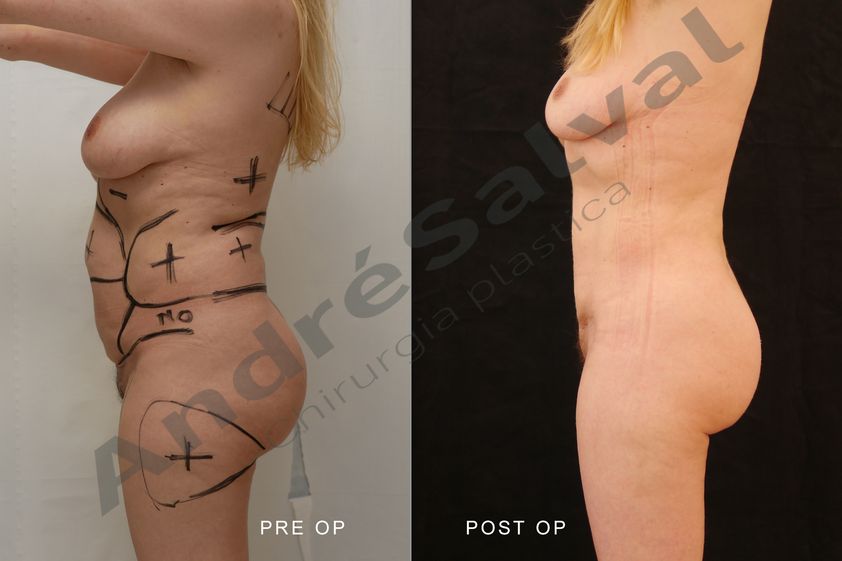 Lipo Vaser prima e dopo - 875130