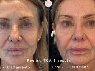 Macchie della pelle prima e dopo - 877354