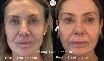 Dott. André Salval Peeling TCA