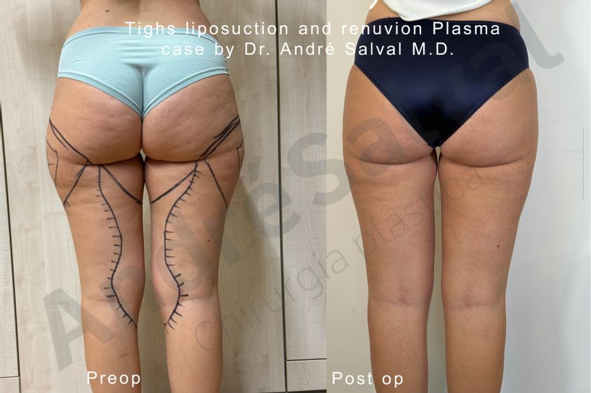 Liposcultura prima e dopo - 877490
