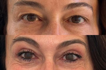 Dott. André Salval Blefaroplastica superiore