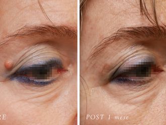 Asportazione nei prima e dopo - 878633