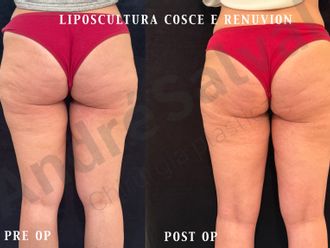 Liposuzione prima e dopo - 879265