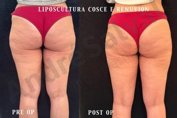 Dott. André Salval lipo e renuvion cosce