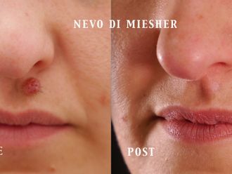 Asportazione nei prima e dopo - 880410
