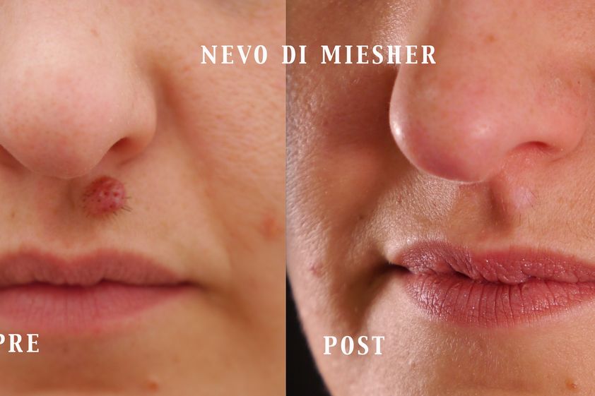 Asportazione nei prima e dopo - 880410