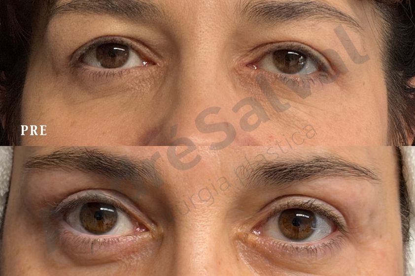 Blefaroplastica prima e dopo - 881053
