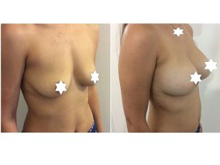 Mastoplastica additiva pre e post