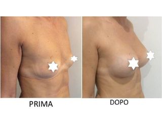 Mastoplastica additiva prima e dopo