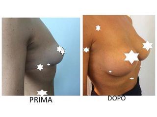 Mastoplastica additiva risultato