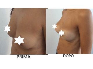 Mastoplastica additiva prima e dopo