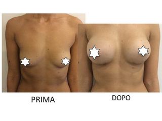 Mastoplastica additiva pre e post